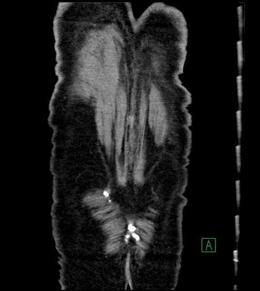 File:Acute arterial mesenteric ischemia (Radiopaedia 78238-90828 Coronal C+ portal venous phase 86).jpg