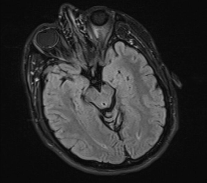 File:Acute ischemic stroke - posterior circulation territory (Radiopaedia 77670-89880 Axial FLAIR 10).jpg