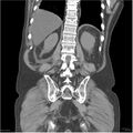 Acute pancreatitis (Radiopaedia 19135-19116 Coronal non-contrast 38).jpg
