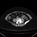 Acute pancreatitis - Balthazar C (Radiopaedia 26569-26714 Axial non-contrast 62).jpg