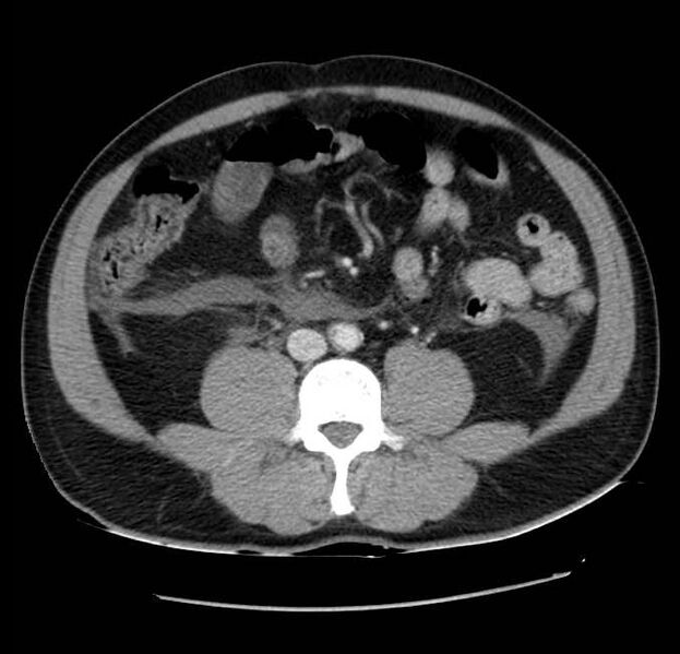File:Acute pancreatitis - Balthazar E (Radiopaedia 23080-23110 Axial C+ portal venous phase 41).jpg
