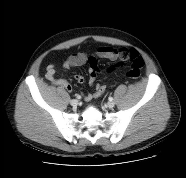 File:Acute pancreatitis - Balthazar E (Radiopaedia 23080-23110 Axial C+ portal venous phase 56).jpg
