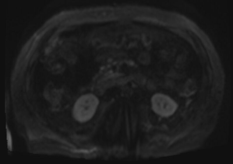 File:Acute portal vein thrombosis (Radiopaedia 73198-83925 Axial DWI 53).jpg