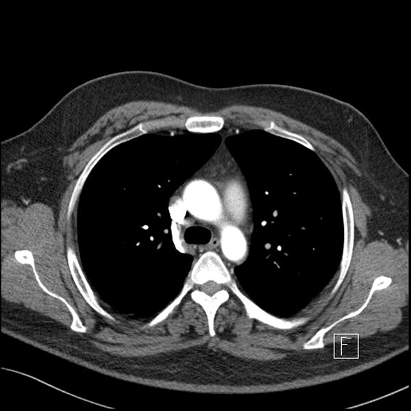 File:Acute pulmonary embolism with pulmonary infarct (Radiopaedia 73062-83768 Axial C+ CTPA 24).jpg