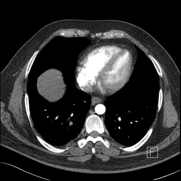 File:Acute pulmonary embolism with pulmonary infarct (Radiopaedia 73062-83768 Axial C+ CTPA 55).jpg