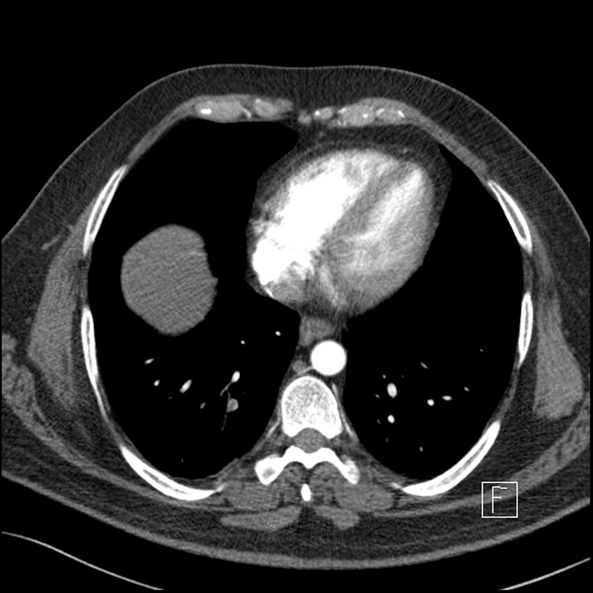 Acute pulmonary embolism with pulmonary infarct (Radiopaedia 73062-83768 Axial C+ CTPA 55).jpg