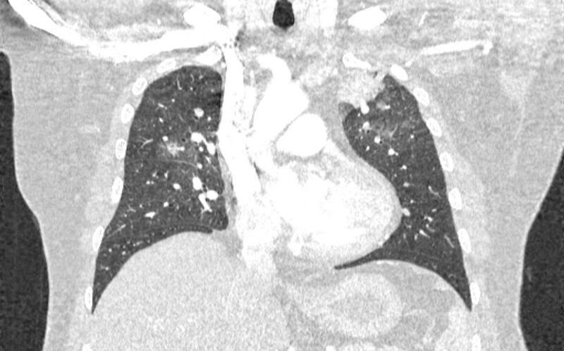 File:Acute pulmonary embolism with pulmonary infarcts (Radiopaedia 77688-89908 Coronal lung window 36).jpg
