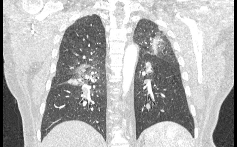 File:Acute pulmonary embolism with pulmonary infarcts (Radiopaedia 77688-89908 Coronal lung window 70).jpg