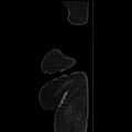 Acute pyelonephritis (Radiopaedia 25657-25837 Sagittal renal parenchymal phase 80).jpg