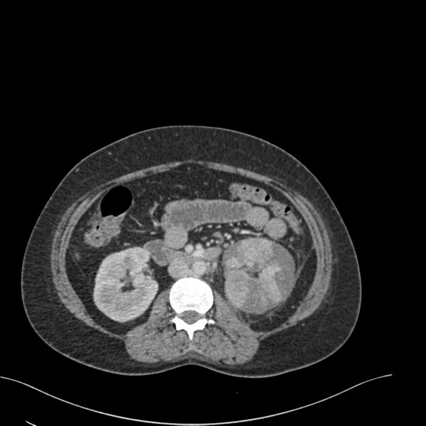 File:Acute pyelonephritis with renal vein thrombosis (Radiopaedia 58020-65053 Axial renal parenchymal phase 76).jpg