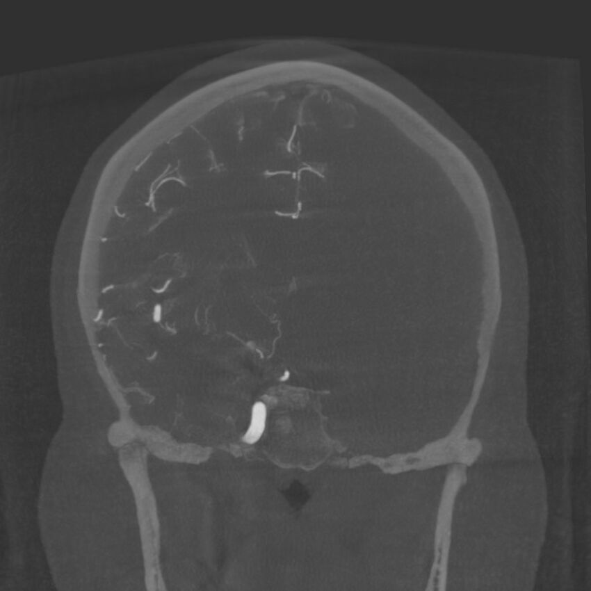Acute subarachnoid hemorrhage and accessory anterior cerebral artery (Radiopaedia 69231-79010 Coronal arterial - MIP 50).jpg