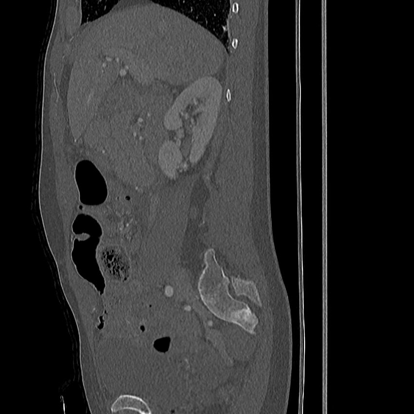 Acute vertebral body compression fractures (Radiopaedia 31757-32693 Sagittal bone window 49).jpg
