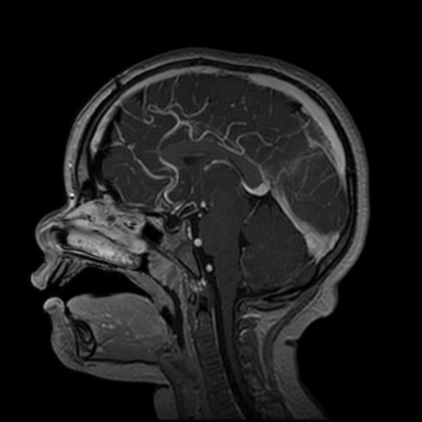 Adamantinomatous craniopharyngioma (Radiopaedia 77407-89529 H 59).jpg