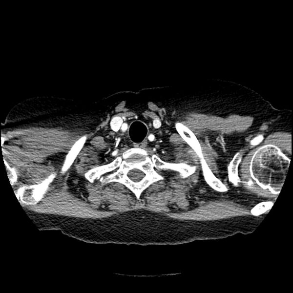 File:Adenocarcinoma of the lung (Radiopaedia 41015-43755 Axial C+ portal venous phase 6).jpg