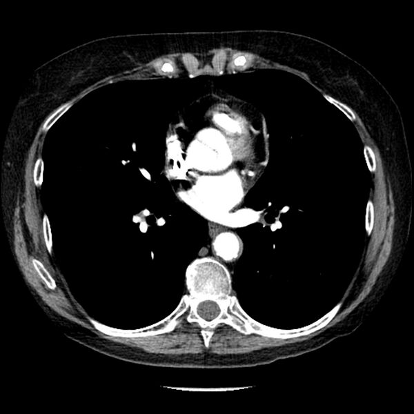 File:Adenocarcinoma of the lung (Radiopaedia 41015-43755 Axial C+ portal venous phase 70).jpg