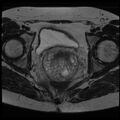 Adenoma malignum of the cervix (Radiopaedia 24460-24765 C 16).jpg