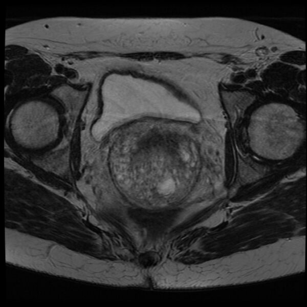 File:Adenoma malignum of the cervix (Radiopaedia 24460-24765 C 16).jpg