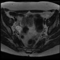 Adenoma malignum of the cervix (Radiopaedia 24460-24765 C 4).jpg