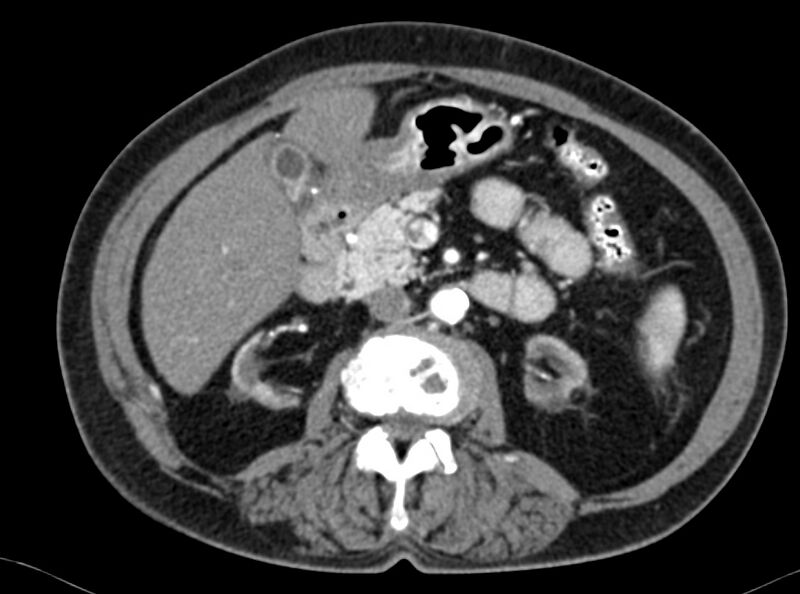 File:Adenomyomatosis of the gallbladder (Radiopaedia 12142-12483 Axial C+ arterial phase 15).jpg
