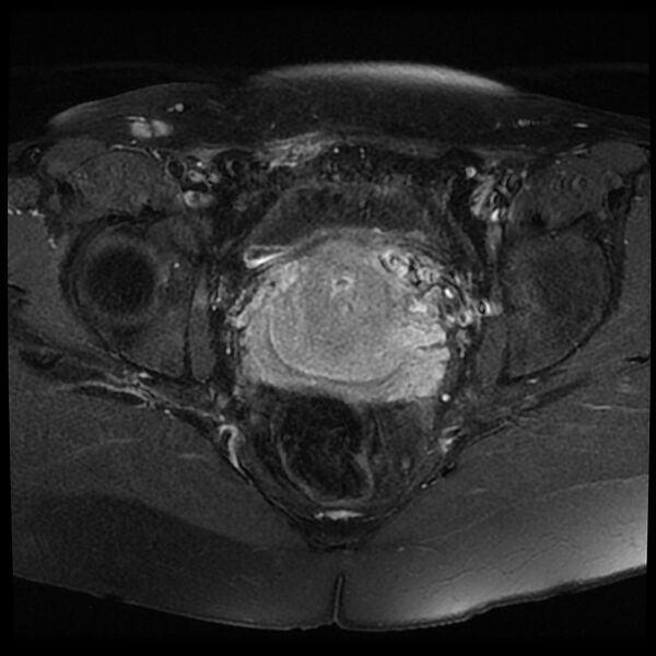 File:Adenomyosis-scar endometriosis (Radiopaedia 65863-75022 Axial T1 C+ fat sat 16).jpg