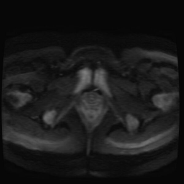 File:Adenomyosis on MRI (Radiopaedia 29328-29780 Axial DWI 14).jpg