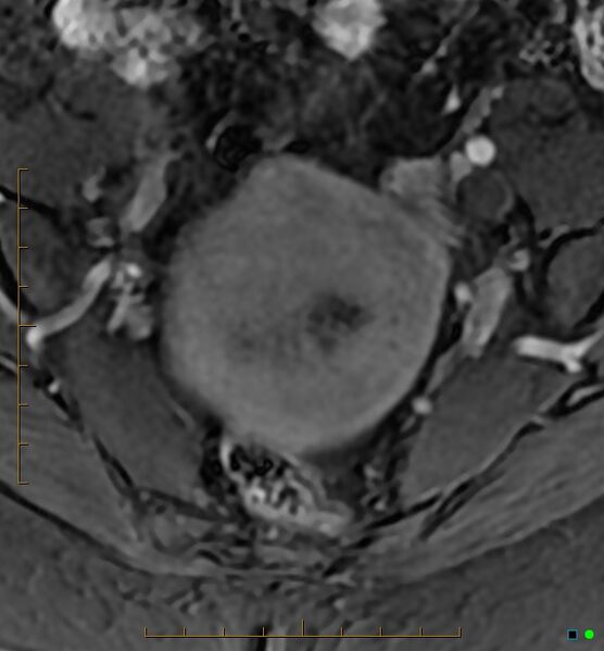 File:Adenomyosis uterus with hematometra (Radiopaedia 45779-50011 Axial T1 C+ fat sat 11).jpg