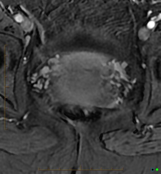 File:Adenomyosis uterus with hematometra (Radiopaedia 45779-50011 Axial T1 C+ fat sat 47).jpg