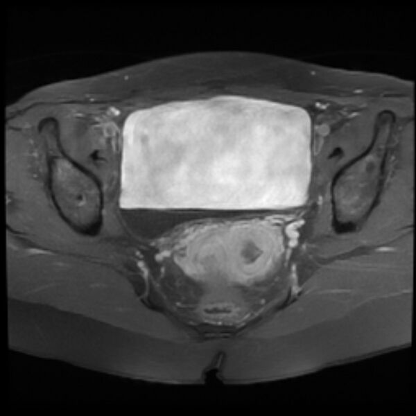 File:Adenomyosis within a septate uterus (Radiopaedia 69963-79981 Axial T1 C+ fat sat 17).jpg