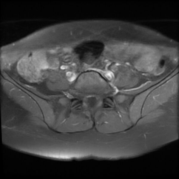 File:Adenomyosis within a septate uterus (Radiopaedia 69963-79981 Axial T1 C+ fat sat 4).jpg