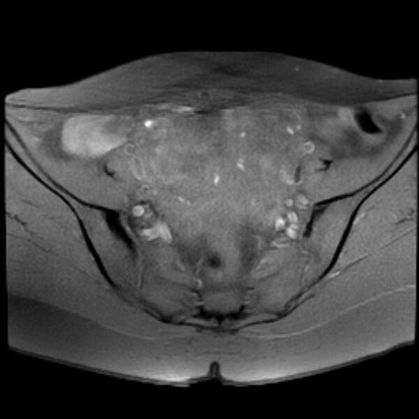 File:Adenomyosis within a septate uterus (Radiopaedia 69963-79981 Axial T1 fat sat 11).jpg