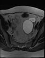 Adnexal multilocular cyst (O-RADS US 3- O-RADS MRI 3) (Radiopaedia 87426-103754 Axial T2 10).jpg