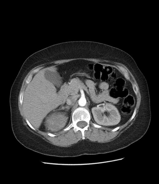 File:Adrenal cortical carcinoma with IVC invasion and thrombosis (Radiopaedia 34307-35597 Axial C+ arterial phase 30).jpg