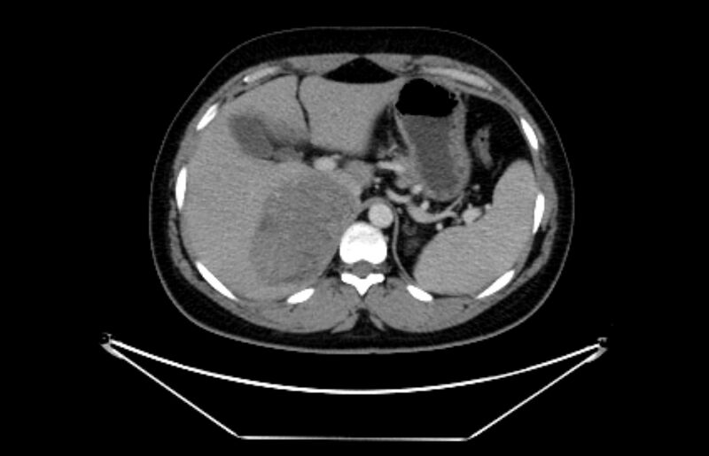 File:Adrenocortical carcinoma (Radiopaedia 80134-93438 Axial C+ portal venous phase 34).jpg