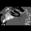 Ameloblastic fibro-odontoma (Radiopaedia 18843-18780 bone window 5).jpg