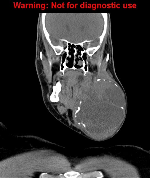 File:Ameloblastoma (Radiopaedia 33126-34164 D 29).jpg