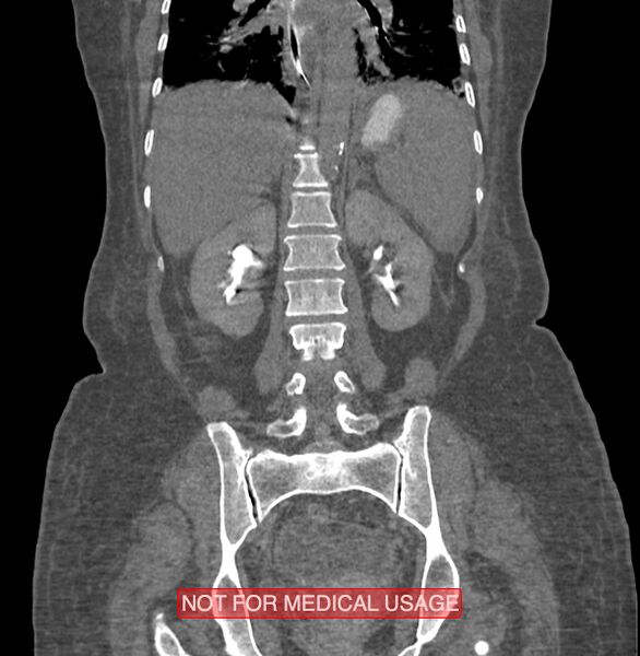 File:Amoebic enterocolitis with liver abscess (Radiopaedia 35100-36609 B 138).jpg