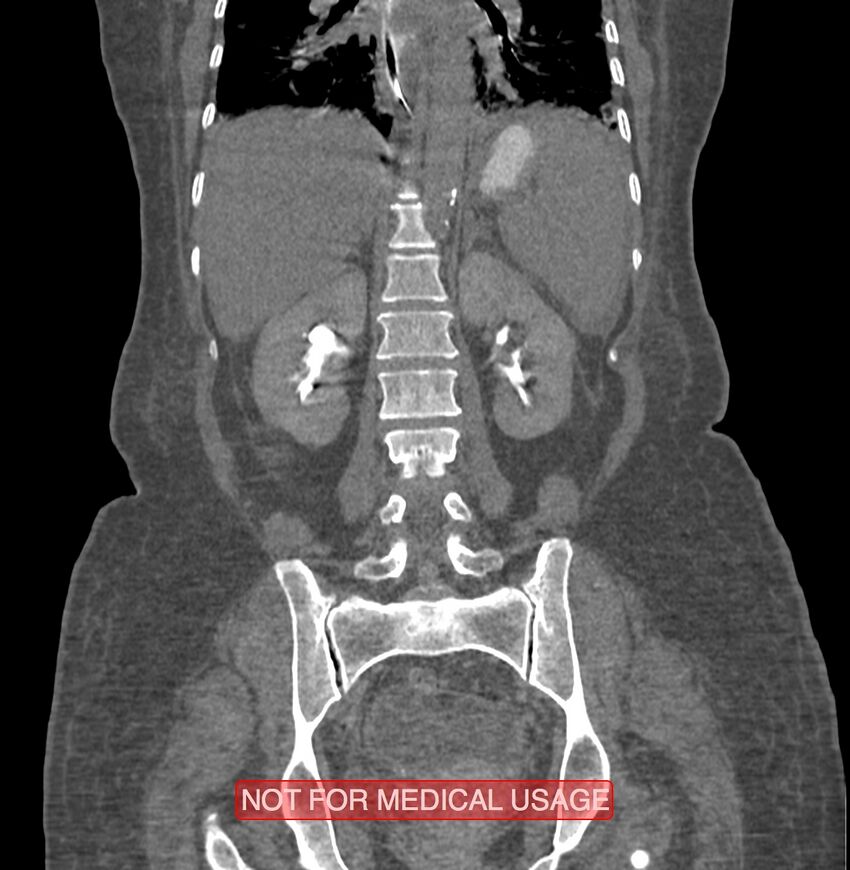 Amoebic enterocolitis with liver abscess (Radiopaedia 35100-36609 B 138).jpg