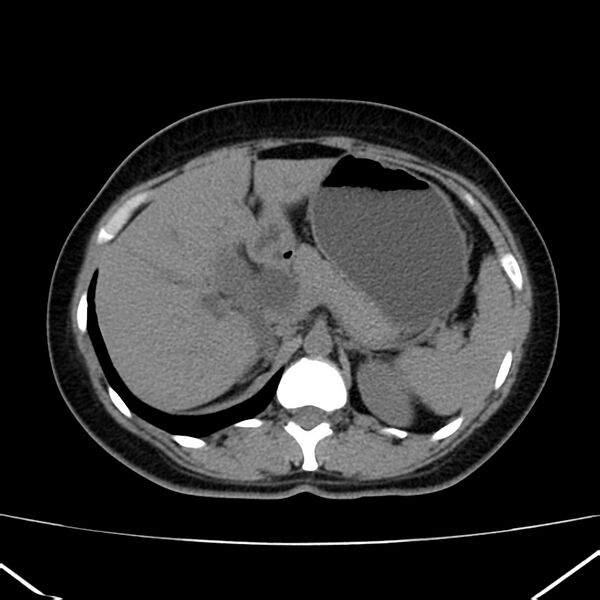 File:Ampullary tumor (Radiopaedia 22787-22816 Axial non-contrast 16).jpg