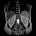 Ampullary tumor (Radiopaedia 27294-27479 Coronal T2 21).jpg