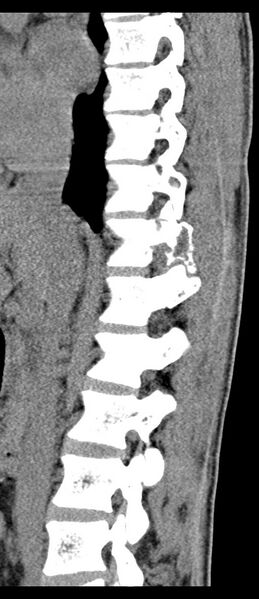 File:Aneurysmal bone cyst T11 (Radiopaedia 29294-29721 E 50).jpg