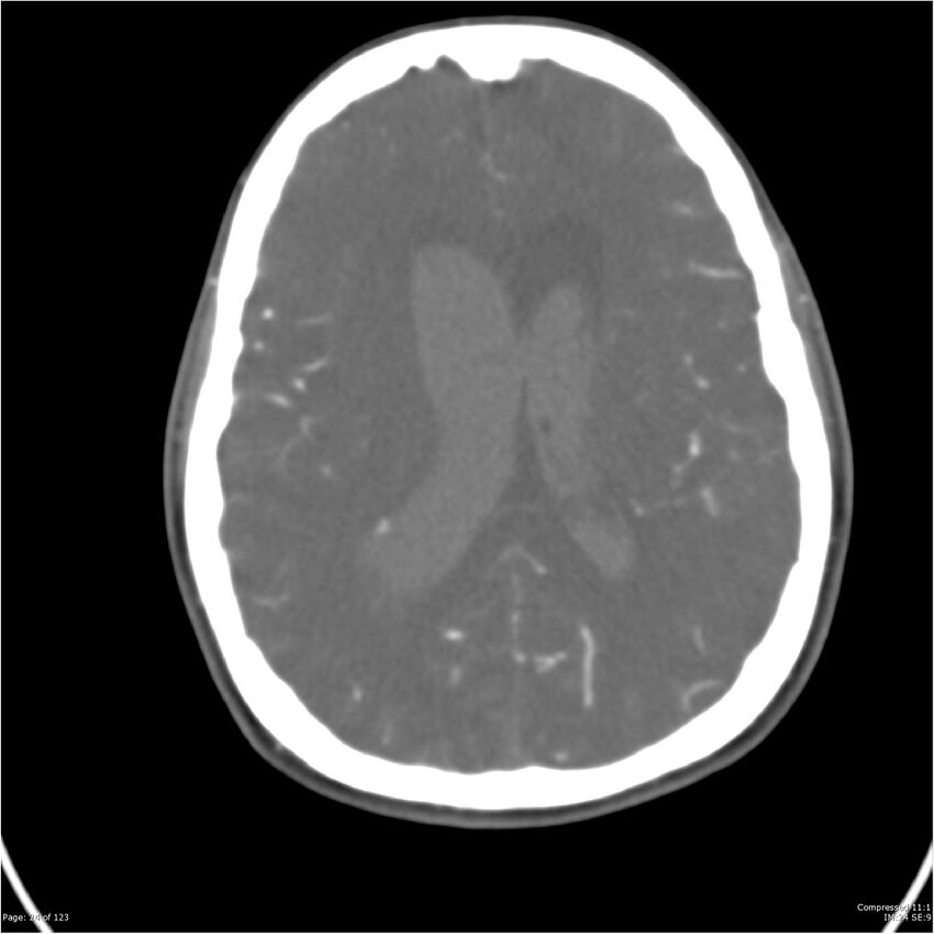 Aneurysmal subarachnoid hemorrhage and Moya Moya disease (Radiopaedia 34306-35593 Axial CT COW 24).jpg