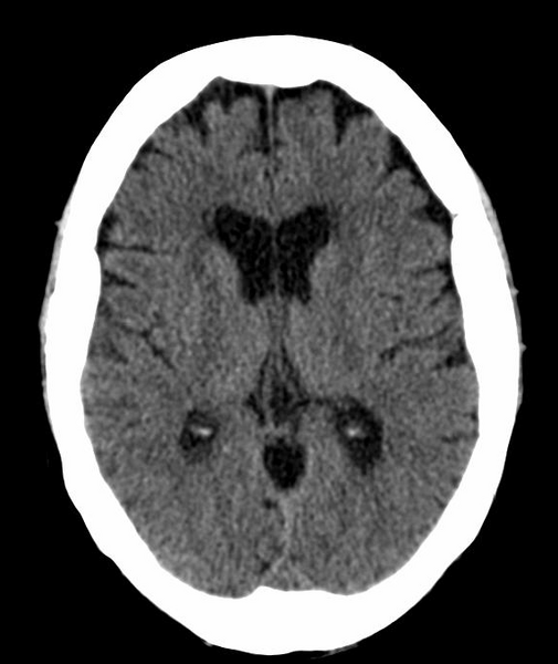 File:Anomalous intracranial venous drainage (Radiopaedia 28161-28418 Axial 19).png