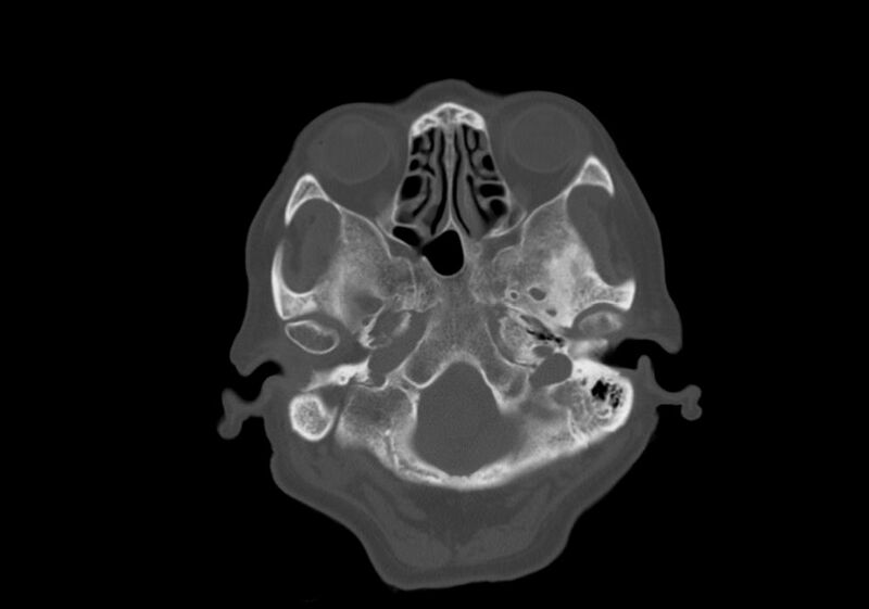 File:Anomalous intracranial venous drainage (Radiopaedia 28161-28418 Axial bone window 4).jpg