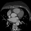 Anomalous origin of left circumflex artery from right coronary sinus (Radiopaedia 72563-83117 B 49).jpg