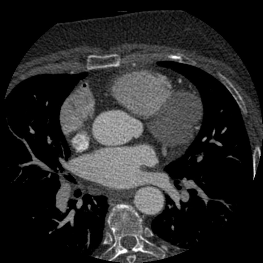 Anomalous origin of left circumflex artery from right coronary sinus (Radiopaedia 72563-83117 B 49).jpg