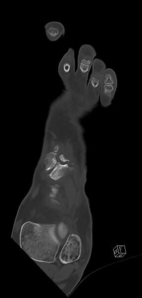 File:Anterior calcaneal process fracture (Radiopaedia 63353-71943 Coronal bone window 14).jpg