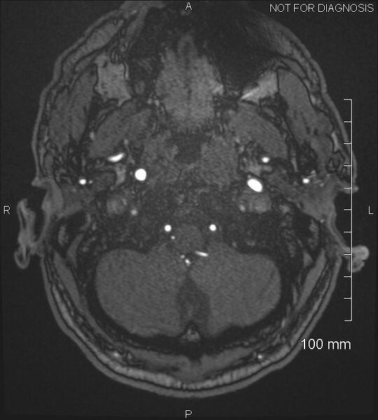 File:Anterior cerebral artery aneurysm (Radiopaedia 80683-94127 Axial MRA 14).jpg
