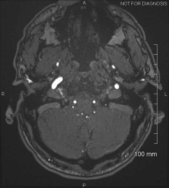 File:Anterior cerebral artery aneurysm (Radiopaedia 80683-94127 Axial MRA 23).jpg