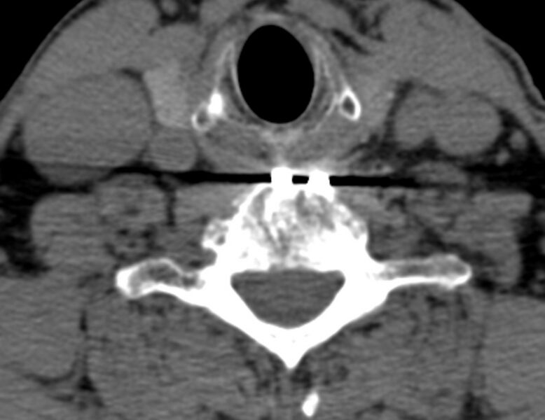 File:Anterior cervical postdiscectomy arthrodesis (Radiopaedia 32678-33646 Axial non-contrast 56).jpg