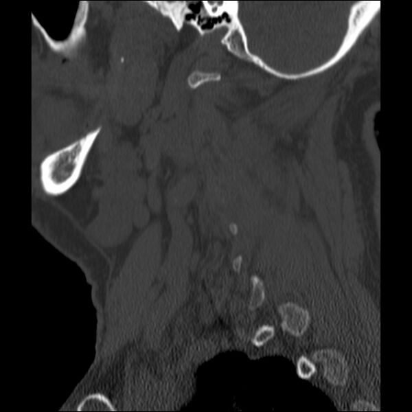 File:Anterior cervical postdiscectomy arthrodesis (Radiopaedia 32678-33646 Sagittal bone window 67).jpg